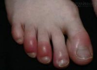 Mẹo phòng và trị cước chân tay hiệu nghiệm trong mùa đông