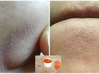 Độc chiêu khiến mụn cám tự chui ra không cần phải nặn
