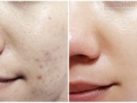 Đắp 2 công thức này lên da, sẹo và vết thâm sẽ biến mất sau 3 tuần