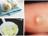 Mụn cóc biến mất vĩnh viễn chỉ nhờ vài nhánh tỏi