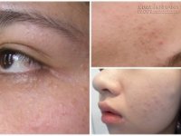 Tuyệt chiêu siêu dễ giúp đánh bay 100% mụn chìm, mụn ẩn li ti dưới da