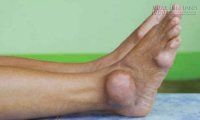 Loại thực phẩm đơn giản nhưng lại hỗ trợ điều trị gút tốt không ngờ