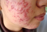 Ẩn họa từ corticoid - Vẫn còn thời sự...