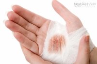 Cách xử lý nhanh các vết thương chảy máu tại nhà