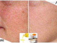 Bất ngờ với cách trị nám vĩnh viễn từ dầu ăn