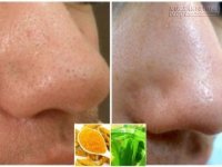 Thổi bay mụn đầu đen trong nháy mắt bằng nguyên liệu rẻ như cho