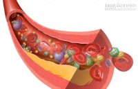 Công thức nước uống thông tắc động mạch, làm sạch mỡ máu