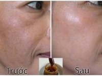 Nám da có nặng và lâu năm đến đâu, cứ áp dụng hỗn hợp dưới đây chắc chắn khỏi