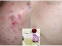 Đánh sạch lũ mụn đáng ghét chỉ bằng 1 nguyên liệu duy nhất