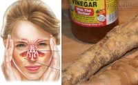 Viêm xoang lâu năm cũng hết ngay lập tức với hỗn hợp sau đây