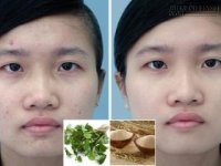 Hỗn hợp rẻ bèo thổi bay mụn cám cực đỉnh