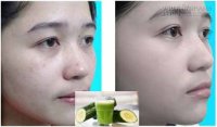 Thần dược rẻ tiền thổi sạch chân nám, tàn nhang vĩnh viễn siêu hiệu quả
