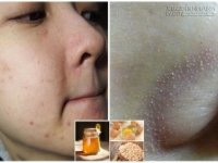 Da trắng bóc, sạch mụn cám chỉ sau 1 tuần với mặt nạ thần thánh dưới đây