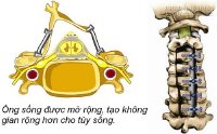 Tê mỏi tay lâu ngày coi chừng bị hẹp ống sống cổ do thoái hóa