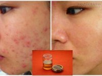 Sạch bong mụn sau 1 ngày nhờ nguyên liệu có nhiều trong bếp ít ai hay