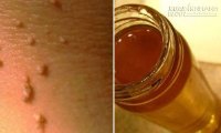 Triệt mụn thịt trong vòng 10 ngày chỉ với 1 nguyên liệu đơn giản
