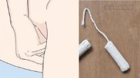 Tự phát hiện ung thư cổ tử cung chỉ bằng 1 chiếc tampon