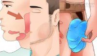 Bệnh quai bị mắc một lần có thể vô sinh cả đời