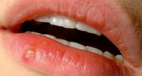 Những lý do không ngờ đến khiến bạn bị lở loét miệng