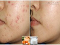 Công thức thần thánh trị dứt điểm mụn trứng cá trong 2 tuần bạn nên thử ngay