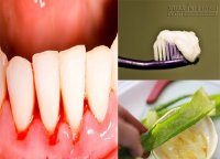 Tự chữa chảy máu chân răng tại nhà bạn nên biết