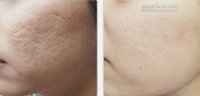 Những điều cấm kỵ bạn cần nhớ để không bi sẹo sau mụn
