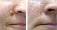 Cách trị mụn cóc, mụn cơm với giấm táo không để lại sẹo
