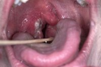 Làm thế nào hết viêm họng nhanh và tốt nhất nếu không có kháng sinh