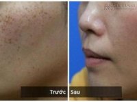 Không ngờ loại trà này lại có thể thổi sạch nám, tàn nhang vĩnh viễn