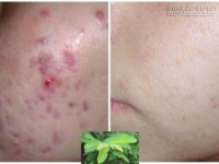 Loại lá ai cũng tưởng vứt đi nhưng lại thổi sạch tất cả các loại mụn