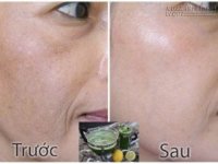 Công thức thần thánh giúp xóa sạch tàn nhang và đốm đen trên da chỉ sau 1 tuần