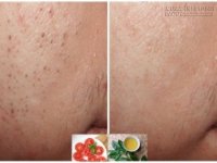 Tạm biệt mụn đầu đen lì lợm trong 5 phút chỉ từ nguyên liệu chưa đến 2k