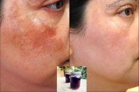 Bất ngờ với nước bí đao thổi sạch chân nám vĩnh viễn dễ như trở bàn tay