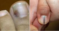 Nếu thấy dấu hiệu này dưới móng tay, bạn phải đi gặp bác sĩ ngay