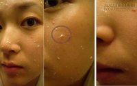 Mẹo cực hay tẩy tế bào chết cho da bị mụn trứng cá