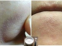 Tuyệt chiêu xóa bỏ kẻ thù mụn cám tận gốc chỉ 15 phút cực đơn giản mà hiệu quả