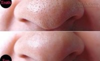 Diệt sạch mụn cám cấp tốc nơi cánh mũi chỉ với bí quyết cực đơn giản