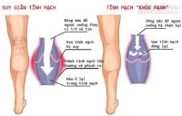 Các bài thuốc trị viêm tắc tĩnh mạch