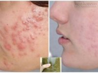 Mụn có chi chít đến đâu, cứ áp dụng cách sau sẽ khỏi trong 2 tuần