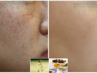 Bất ngờ với mẹo xóa sạch tàn nhang bằng rượu gạo