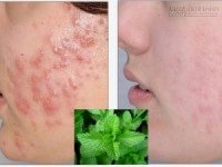 Đánh bay không còn 1 nốt mụn với những loại lá quen thuộc