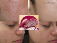 Chẳng cần lo lắng sẹo lõm vì đã có loại củ thân thuộc này