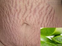 Mẹ bầu không cần lo lắng rạn da vì đã có công thức này