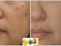 Thổi sạch nám, tàn nhang với 3 loại rau củ chưa đến 5k mà hiệu quả bất ngờ