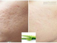 5 phút lấp đầy sẹo rỗ chỉ từ 1 chiếc lá lô hội nên thử ngay