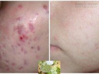 Đắp hỗn hợp này 2 lần/tuần, mụn nhiều đến đâu cũng hết chỉ sau 1 cái nháy mắt