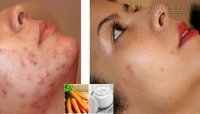 Sạch mụn, hết vết thâm trong 10 ngày giúp nàng đón Tết thêm xinh không nên bỏ lỡ