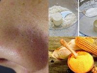 5 cách trị mụn đầu đen hiệu quả ngay sau khi áp dụng