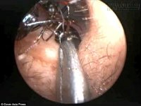 Đi tìm nguyên nhân khiến hơn 1 nghìn con kiến bò ra từ lỗ tai bé gái 12 tuổi