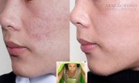 Chỉ 1 phương pháp, tất cả mọi loại mụn đều bị đánh bay